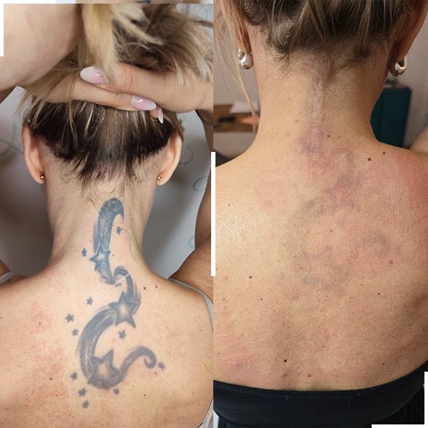 Tatouage avant et après détatouage laser, cas 2