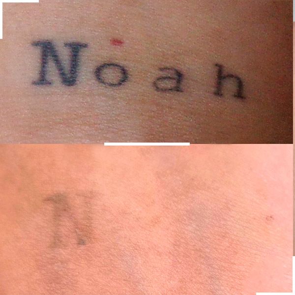 Tatouage avant et après détatouage laser, cas 6