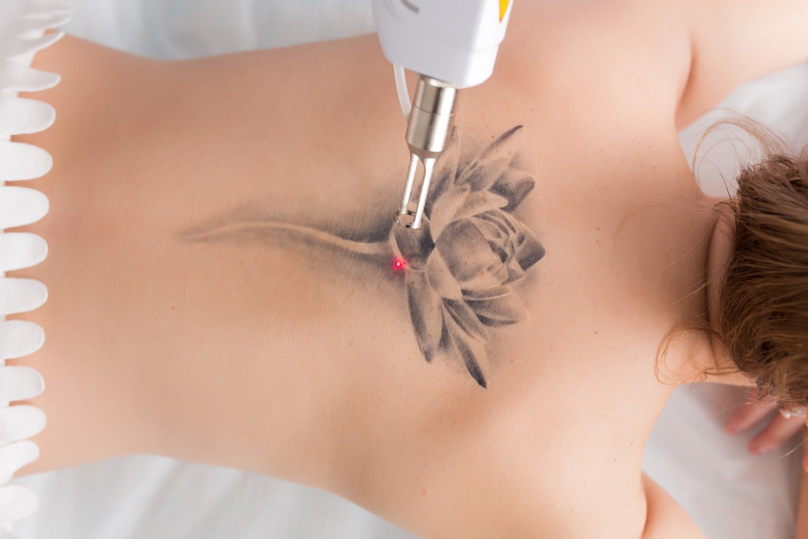 Tarifs détatouage laser, centre Detatou à Nancy