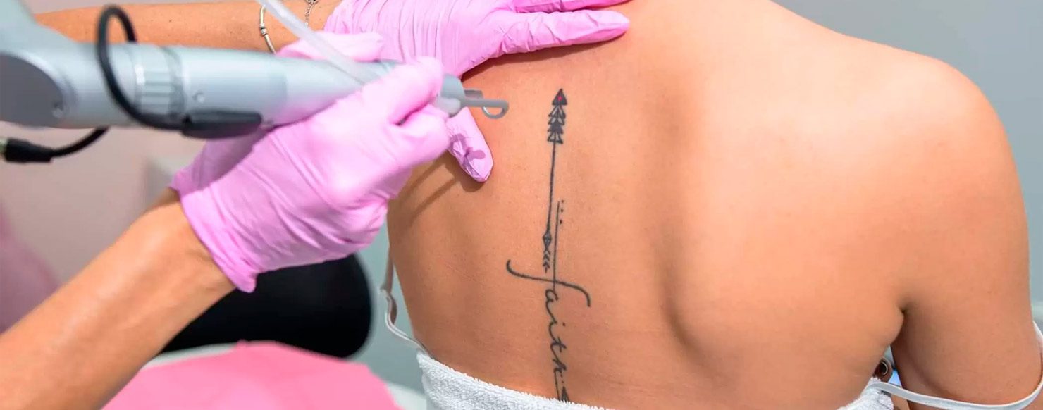 Prix pour enlever un tatouage : guide complet des tarifs en 2026 4