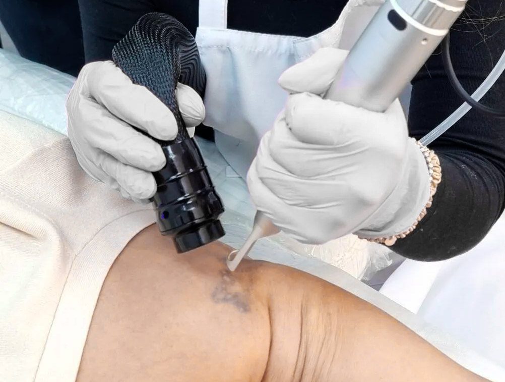 Laser picoseconde : est-il vraiment obligatoire pour un détatouage ? 2 consultation préalable dermatologique avant séance de détatouage laser