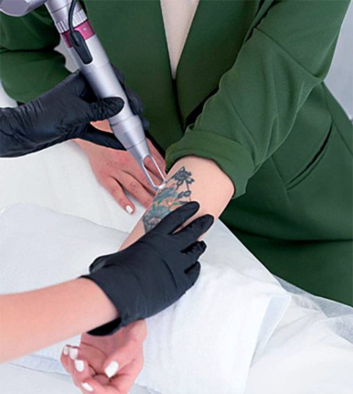 Détatouage laser à Nancy : votre guide complet 2025