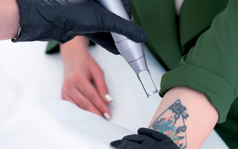 Pourquoi choisir Nancy pour votre détatouage laser ?