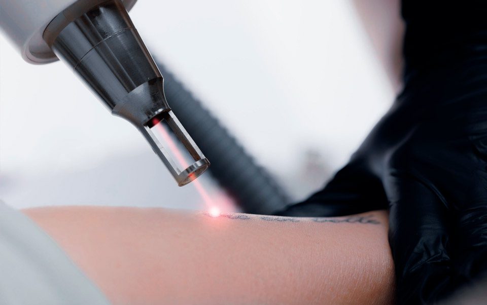 Technologies de détatouage laser Nancy Technologies de détatouage laser Nancy