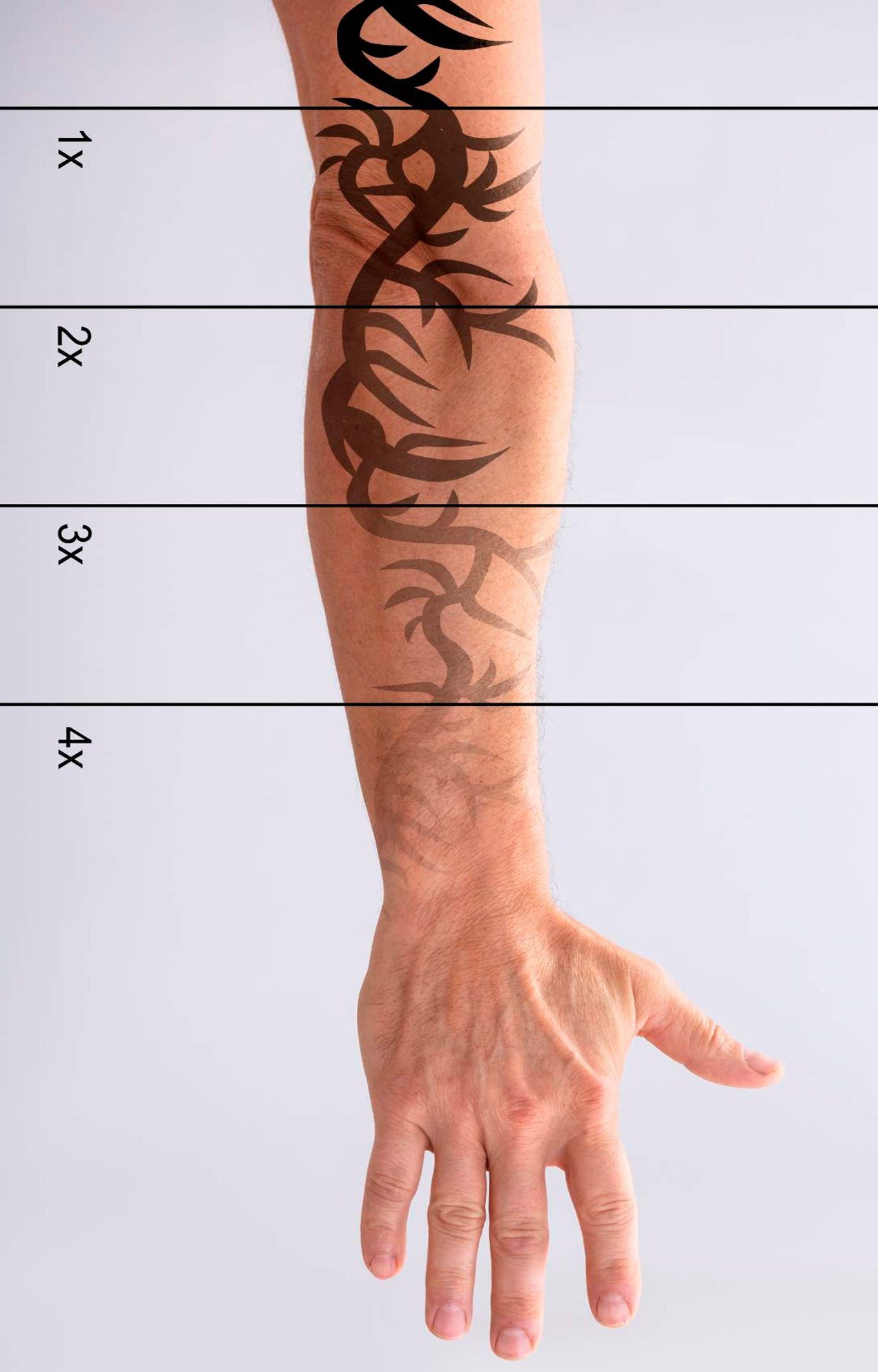 Chaque séance de détatouage nécessite un ajustement précis des paramètres laser selon les caractéristiques spécifiques du tatouage et du patient Chaque séance de détatouage nécessite un ajustement précis des paramètres laser selon les caractéristiques spécifiques du tatouage et du patient