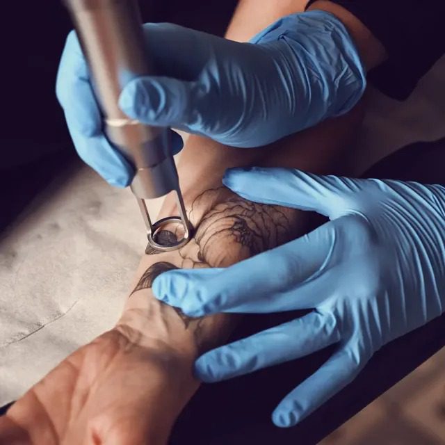 Peau en cours de recuperation apres une seance de laser picoseconde pour detatouage