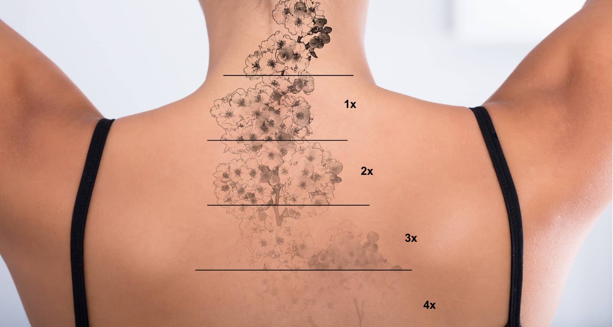 Séance de détatouage laser réalisée par un professionnel en cabinet de dermatologie