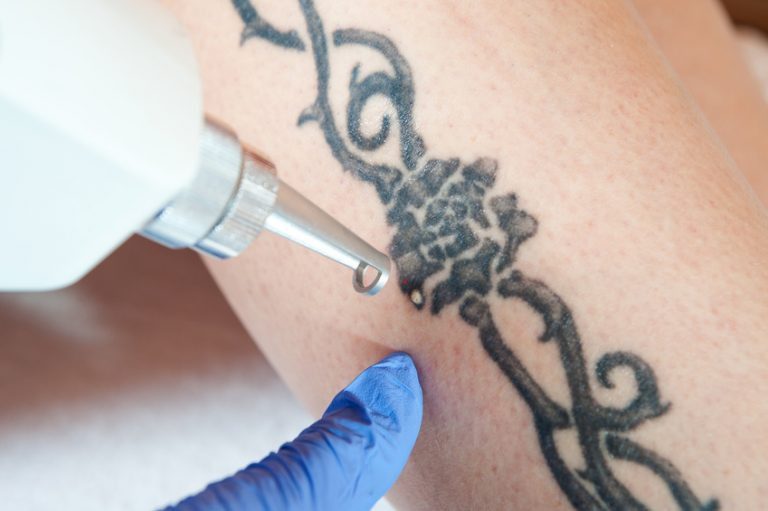 tatouage ancien noir délavé avec encre dispersée dans le derme