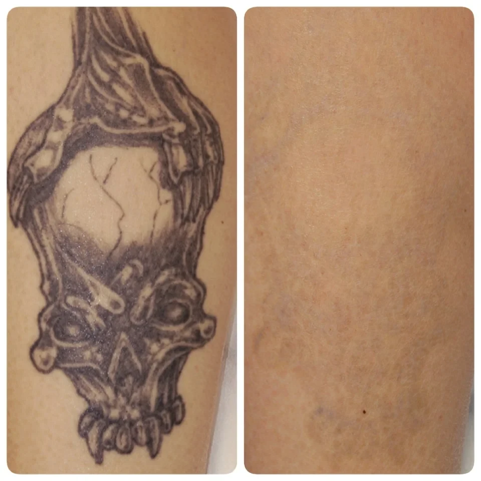 photo avant détatouage laser d'un ancien tatouage noir sur avant-bras