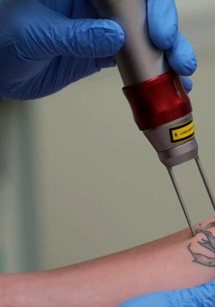 Tarifs détatouage laser à Nancy